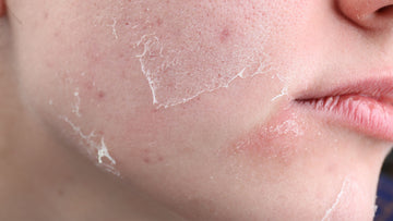 5 Expert Tips for Sensitive, Mature Skin