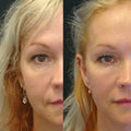 Visible transformation of woman's face before and after using Ageless Bloom Anti Aging Moisturizer, showing firmer skin tone.