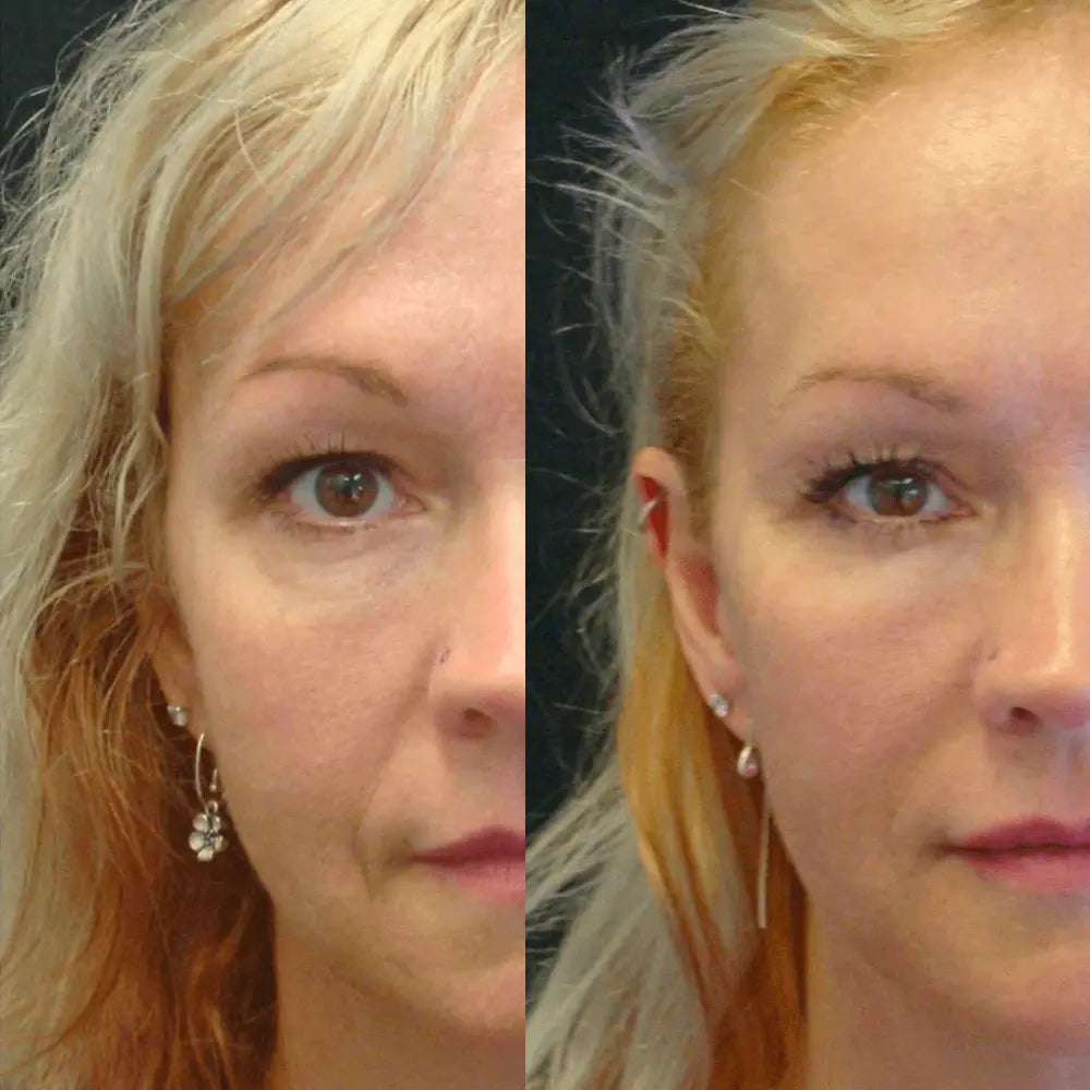 Visible transformation of woman's face before and after using Ageless Bloom Anti Aging Moisturizer, showing firmer skin tone.